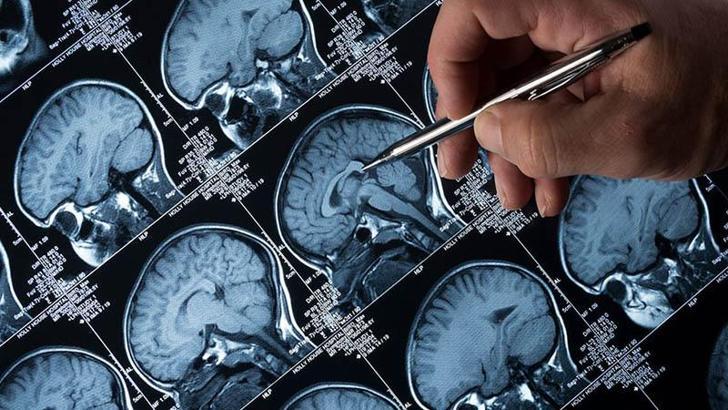 Alzheimer tedavisinde 'lityum' umudu