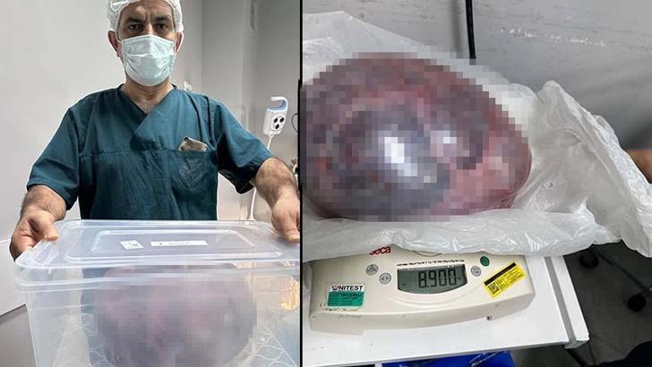 Yumurtalıklarındaki 9 kiloluk kitle operasyonla çıkarıldı