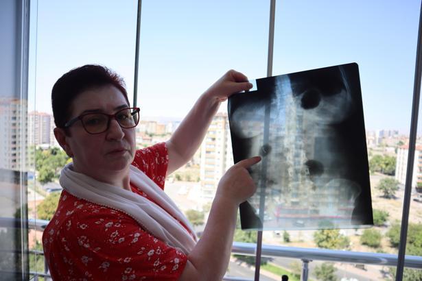 22 yıldır karnında ameliyat iğnesiyle yaşıyor