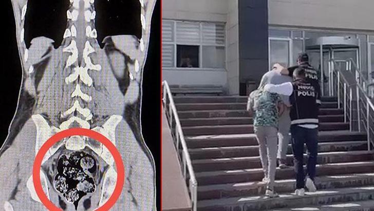 Röntgenle tespit edilen uyuşturucu cerrahi operasyonla çıkarıldı