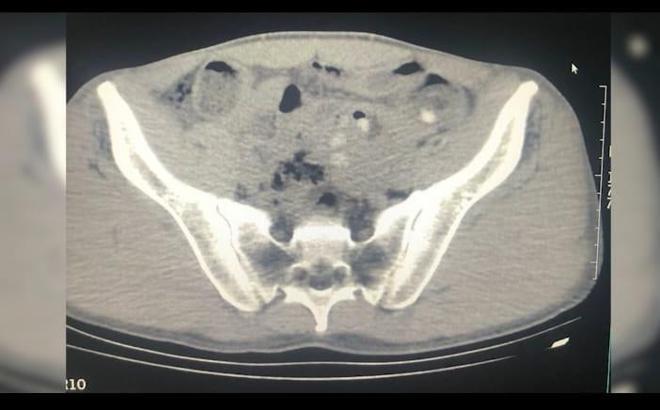 Midelerinde uyuşturucu ile yakalanan yabancı uyruklu 3 şüpheli tutuklandı