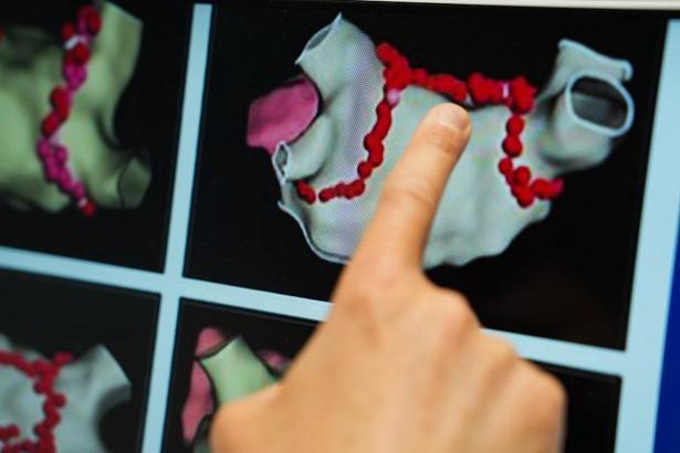 ‘Ablasyon tedavisinde çoğu hasta aynı gün taburcu ediliyor’