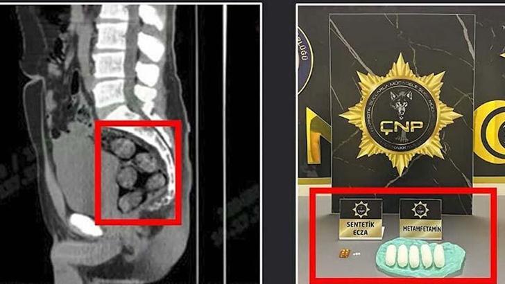 İran'dan midesinde getirdiği 173,15 gram metamfetamin ile yakalandı