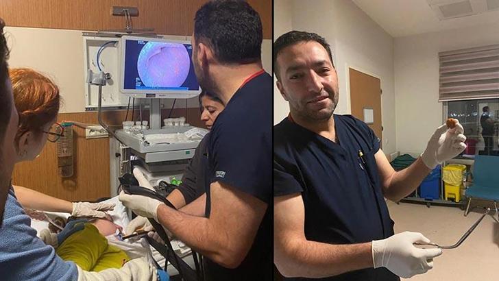 Zihinsel engelli kadının yemek borusuna kaçan ceviz, operasyonla çıkarıldı