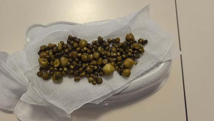 Bursa'da 77 yaşındaki kadının safra kesesinden 213 tane taş çıkarıldı