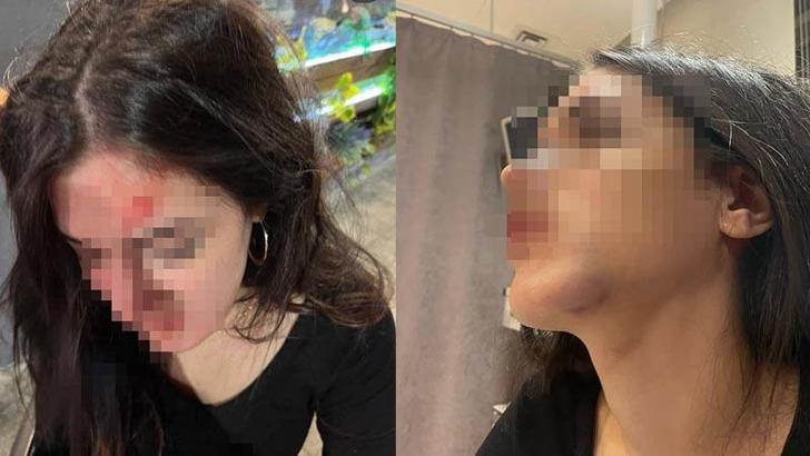 Eski sevgilisi tarafından darbedildiğini iddia edip, fotoğraflarını sosyal medyada paylaştı