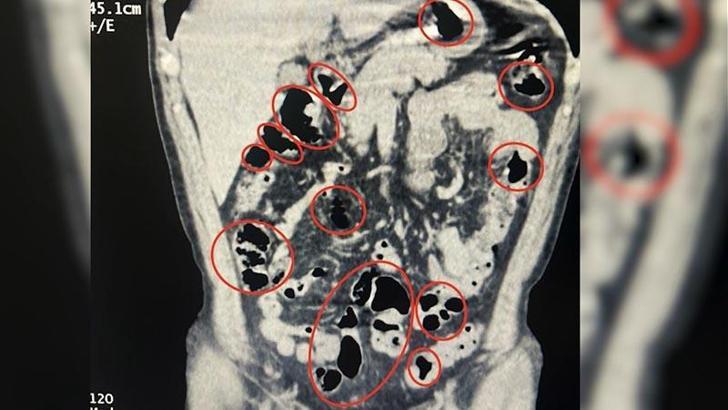 Yabancı uyruklu 2 kişinin mide ve bağırsaklarından uyuşturucu çıktı