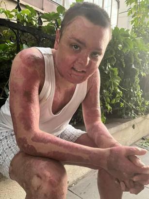 İstanbul - Kağıthane’de kuafördeki yangında tüm vücudu yanan 14 yaşındaki Engin'in tedavisi tamamlandı: Kapı sıkışınca çıkamadım yandım