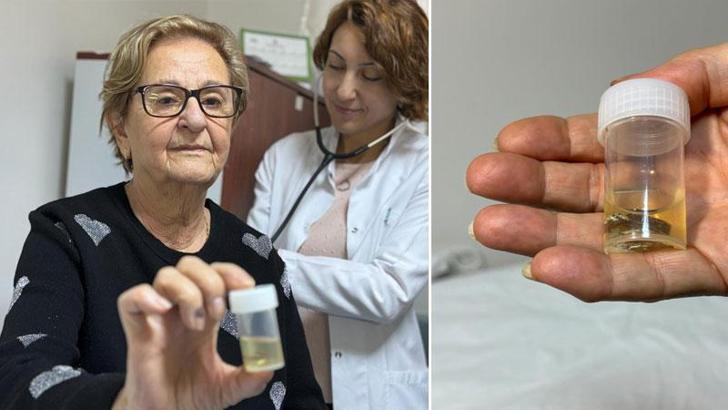 Alüminyum kabıyla yuttuğu hap, 4 yıl sonra akciğerinden çıkarıldı