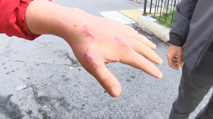 İstanbul- Kedi elini ısırınca hastaneye gitti, parmağındaki tendonun koptuğu iddiasıyla doktordan şikayetçi oldu