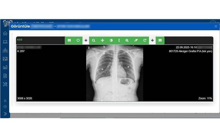 Sağlık Bakanlığı, 'Akciğer Görüntüleme Sistemi'ni hayata geçirdi