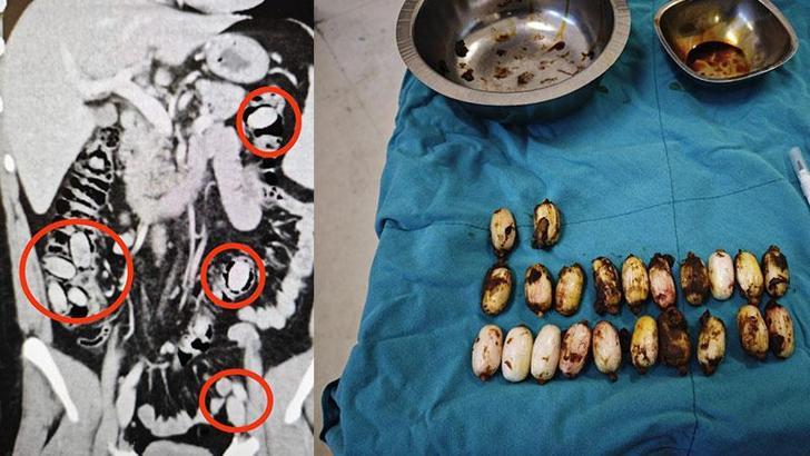 Midesinden 44 kapsül uyuşturucu madde bonzai çıktı