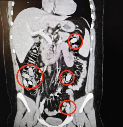 Midesinden 44 kapsül uyuşturucu madde bonzai çıktı