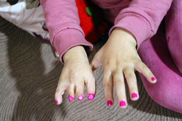 10 ameliyat geçiren yapışık parmak Elif Lina’nın ailesinden çağrı / Ek fotoğraflar