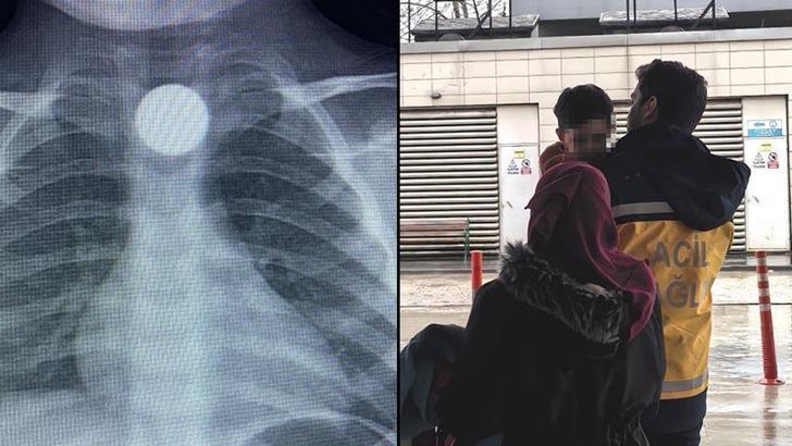 3 yaşındaki Bilal'in, yuttuğu 50 kuruş yemek borusunda takıldı
