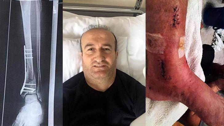 Arkeolojik kazı alanındaki çukura düşünce ayağında yüzde 3'lük engel oluştu; 1 milyon lira tazminat kararı çıktı