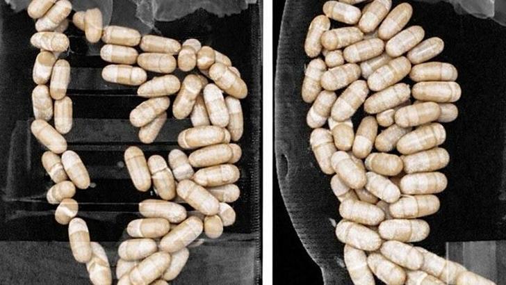 2 şüphelinin midesinden 127 kapsül uyuşturucu çıktı