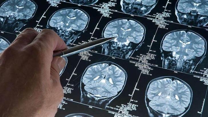 Araştırma: Derin uyku Alzheimer’ı yavaşlatıyor