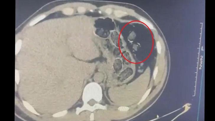 Midelerinden uyuşturucu taşıyan 2 şüpheli tutuklandı