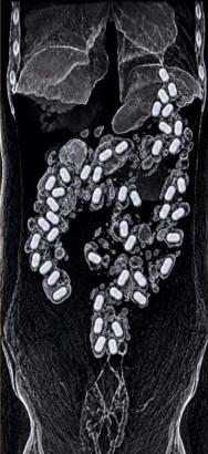 Havalimanında şüpheli yolcunun midesinden 322 gram metamfetamin çıktı