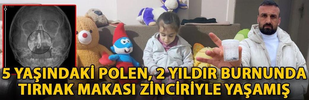 5 yaşındaki Polen, 2 yıldır burnunda tırnak makası zinciriyle yaşamış