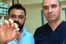 Tükürük bezinden 3 santimetre çapında taş çıktı
