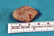 Tükürük bezinden 3 santimetre çapında taş çıktı