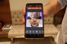 Yüz sarkmalarına karşı 'biyolojik lifting aşısı'