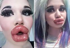 Bulgaristan'da genç kız Barbie’ye özenip 20’den fazla dudak dolgusu yaptırdı