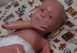 'Yılan bebek' Gökdeniz 1 yaşında