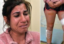 Hayatı kabusa dönen Suriyeli Ceylan: Çocuklarım için yaşamak istiyorum