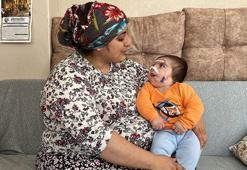 Nadir görülen 'Goldenhar Sendromu' ile dünyaya gelen Asım bebek, ameliyat olmayı bekliyor