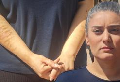 Epilasyon için gittiği güzellik merkezinde kolları yandı