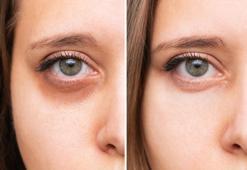 Uzmanı uyardı: Gözaltındaki mor halkalar basit bir cilt problemi olmayabilir