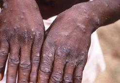 Dr. Alver: Maymun çiçeğinin ölüm oranı düşük