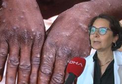 Prof. Dr. Yavuz: Maymun çiçeğinde ilk vaka tespit edildiğinde karantina 28 gün sürebilir