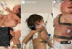 Aynı bedende nefes alan siyam ikizleri 9 saatlik ameliyatla ayrıldı