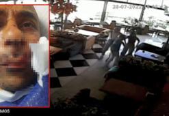 Küçükçekmece'deki pitbullu saldırı: Kulağını kaybetme ihtimali yüzde 90