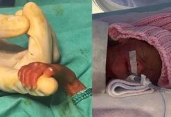 540 gramlık parmak bebek Rabia'yı kök hücre tedavisi hayata bağladı