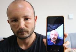 2 gün plaja gitti, başında nadir görülen sıcak ödemi oluştu