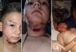 Sahipsiz köpeğin saldırdığı çocuğa 40 dikiş atıldı