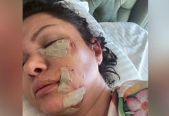 Şile'de köpek saldırısına uğrayan şarkıcı Tuğba Altıntop'un yüzüne dikiş atıldı