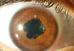 Üveit’te geç muayene kalıcı görme kaybına neden olabilir