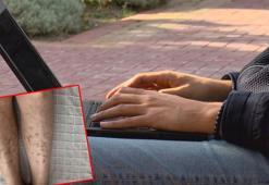 Dizüstü bilgisayar kullanımında deri hastalığı riski