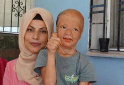 8 yaşındaki Halil'e 3'üncü kez doku nakli yapılacak