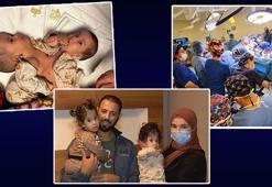 Siyam ikizleri iyileşti taburcu oluyor