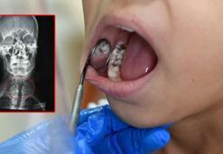Tedavi edilmeyen diş iltihabında ölümcül 'mediastinit' riski