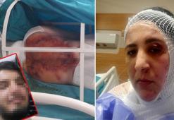 Üvey oğlunun kezzaplı saldırısında vücudunun büyük bölümü yandı