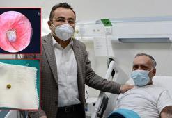 Akciğerine kaçan bezelye ameliyatla çıkarıldı