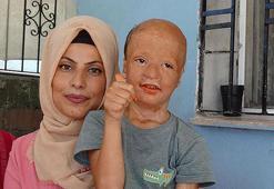 Yangında yaralanan 9 yaşındaki Halil, 3'üncü kez doku nakli için bekliyor